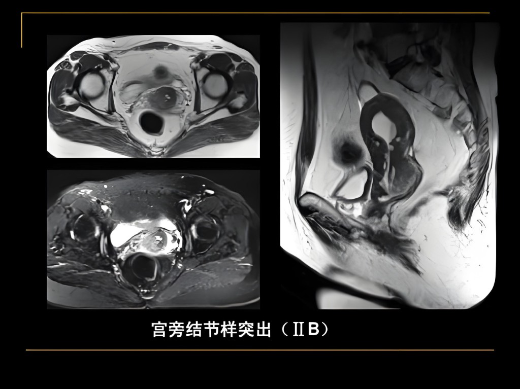 宫颈影像
